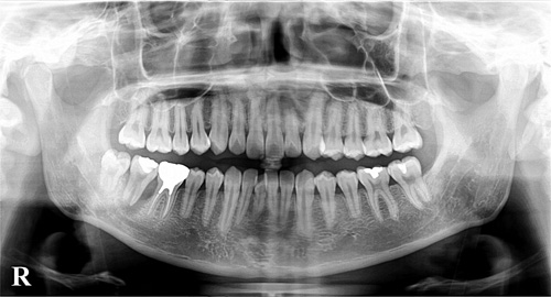 レントゲンパノラマ画像