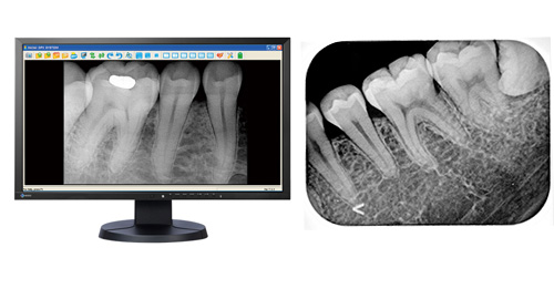 デンタルレントゲン